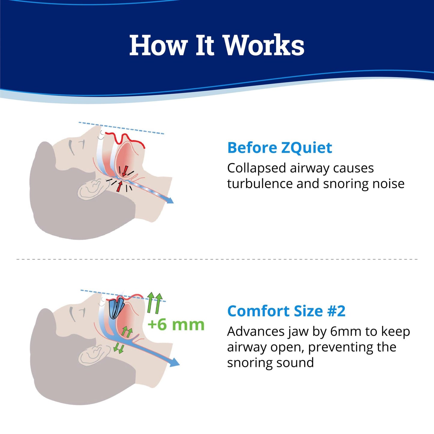 ZQuiet Anti-Snoring Mouthpiece Solution - Comfort Size #2 (Single Device) + Cleaner (1.5oz Bottle) - Made in USA Snoring Solution for a Better Night’s Sleep (Blue)