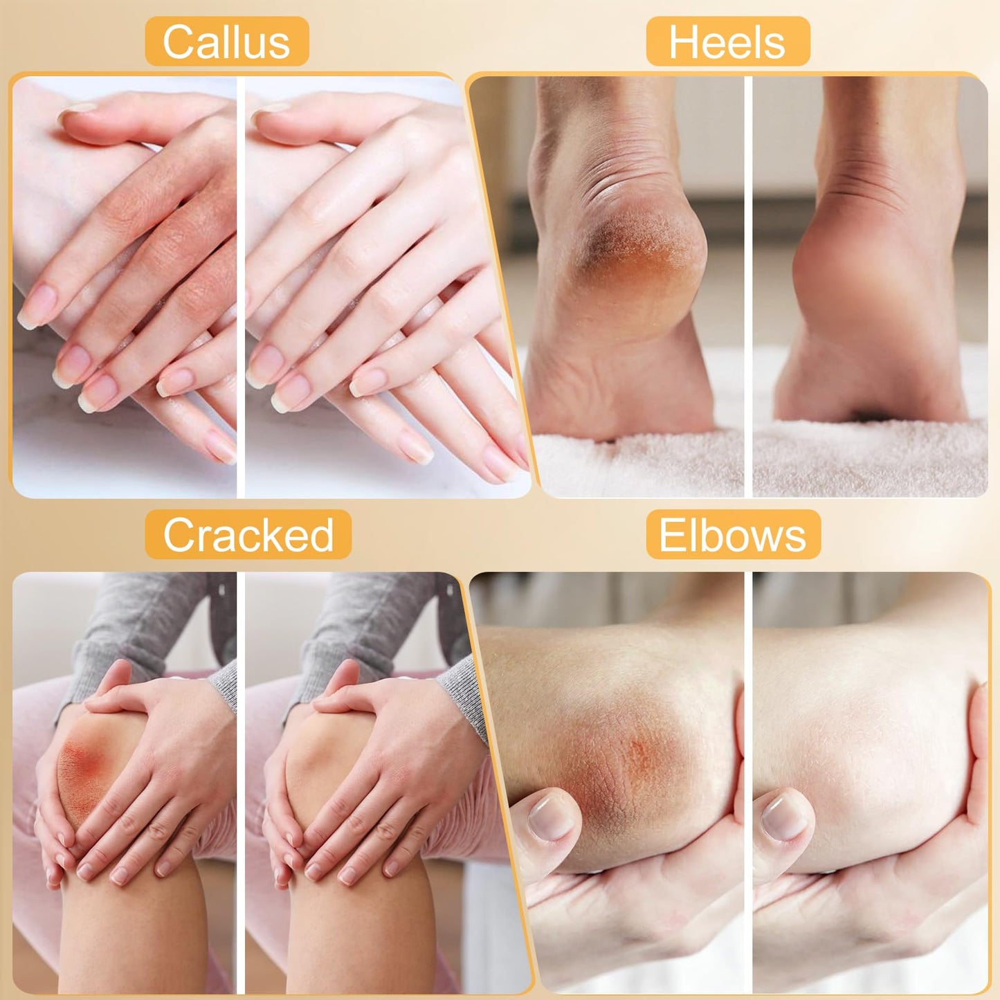 Urea Cream 40%,Urea Cream 42% Plus 2% Salicylic Acid Maximum Strength For Feet,Foot Cream for Dry Cracked Heels Feet Knees Elbow