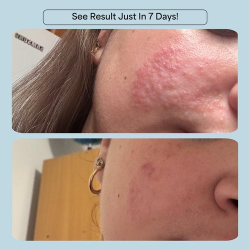 CelRevive B-Restore™ Barrier Cream soothes, hydrates, and supports microbiome balance, restoring comfort to sensitive, dry skin. EWG Verified™ for safety and transparency. Made in Australia