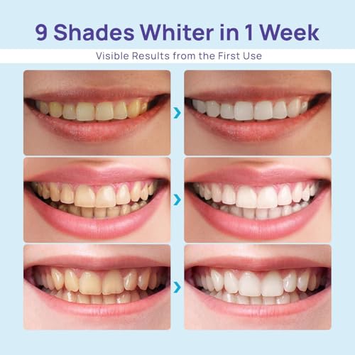 Whitebite Pro Teeth Whitening Kit for Sensitive Teeth – Dual LED Light + 35% Carbamide Peroxide Gel + Remineralizing Gel |...