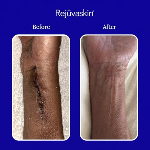 Rejuvaskin Scar Heal Kit for Small Scars, Soften, Flatten, Reduce and Recover, Silicone Sheeting, RejuvaSil Gel & Medical ...