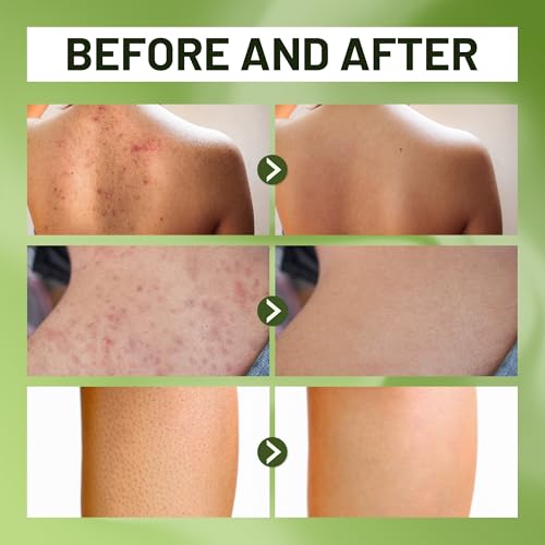 ABERA Folliculitis BHA Shower Gel, High-Performance Folliculitis Body Wash, Wild Bitter Melon Extract, Reduces Back Acne & Hyperkeratosis, 2 Boxes + Gift Grapefruit Hair Regrowth Shampoo for Hair Loss