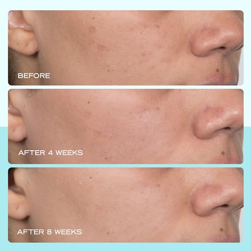 First Aid Beauty - Dark Spot Serum with Niacinamide, Helps Reduce Look of Dark Spots, Sun Spots, Hyperpigmentation, Discol...