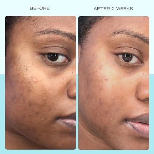 First Aid Beauty - Dark Spot Serum with Niacinamide, Helps Reduce Look of Dark Spots, Sun Spots, Hyperpigmentation, Discol...