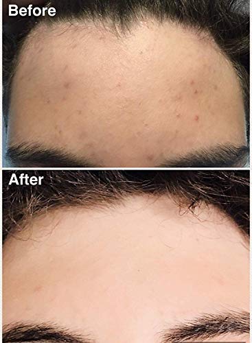 Teenology Shampoo for Teens - Avoid Forehead and Body Breakouts - No Sulfates or Parabens, Noncomedogenic, Natural Botanical Ext