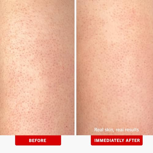 First Aid Beauty - KP Bump Eraser Body Scrub with 10% AHA, Keratosis Pilaris Skin Exfoliater with Glycolic and Lactic acid...