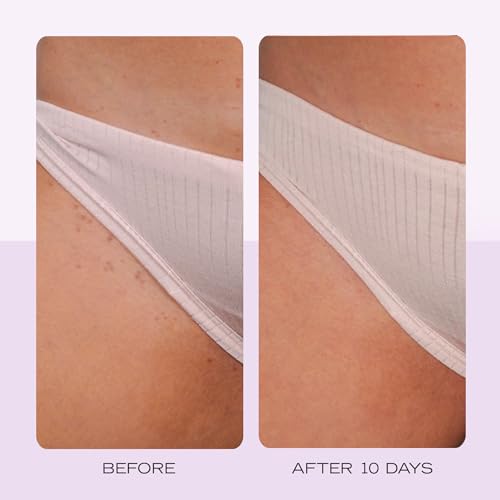 First Aid Beauty - Jumbo Body Duo: KP Bump Eraser Body Scrub & Ingrown Hair Pads with 10% BHA & AHA, Daily Exfoliating Bod...