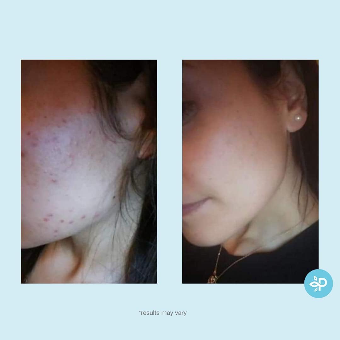 Salicylic 10% Gel Peel, Breakout and Pore Minimizer and Cleanser, 15-30 Full Facial Chemical Peels, 1 fl oz. e, 30 mL - Perfect