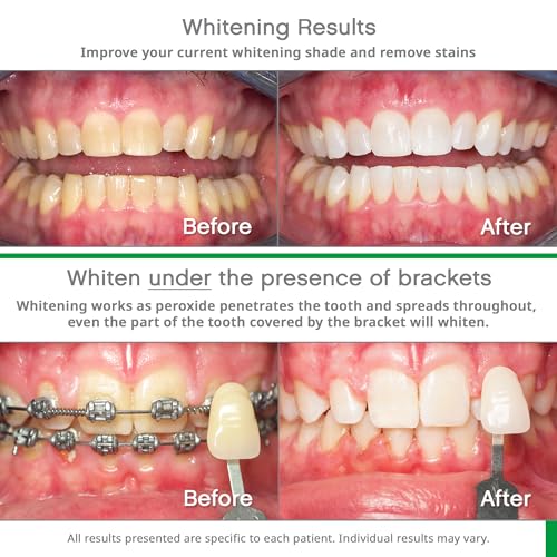 Opalescence Go 15- Prefilled Teeth Whitening Trays - 15% Hydrogen Peroxide - (10 Treatments) Made by Ultradent Products. T...