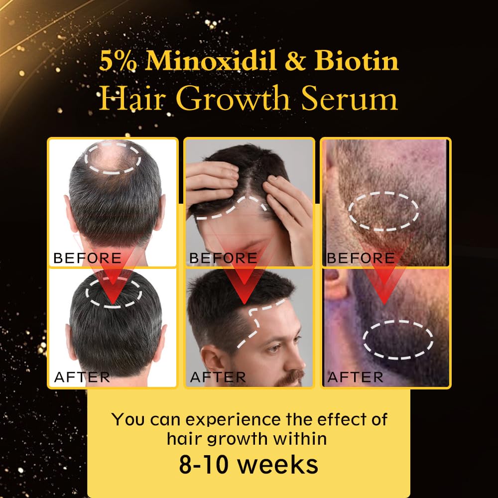 5% Minoxidil Hair Regrowth Oil for Men and Women - Extra Strength Topical Serum for Hair Loss, Promotes Thicker, Healthier Hair