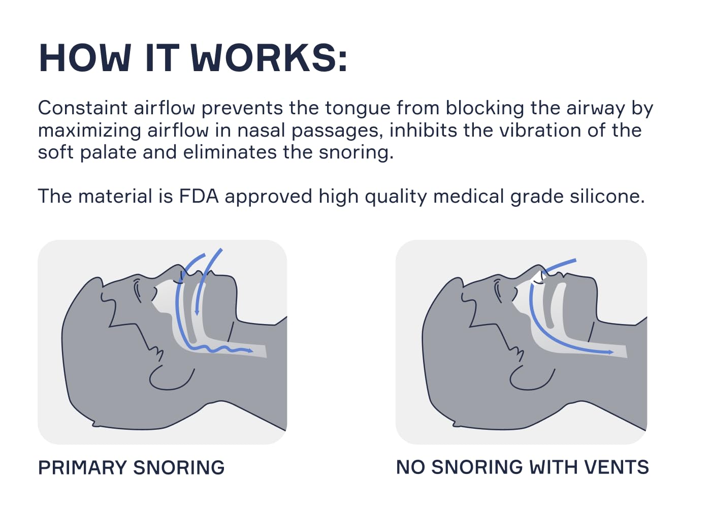 Snore Bastion Nasal Dilators for Sleeping - 4 of X-Large ONLY (XL) Soft Silicone Nasal Cones - Nostril Opener - Nasal Expander for Breathing - Nose Vents - Anti Snoring Devices