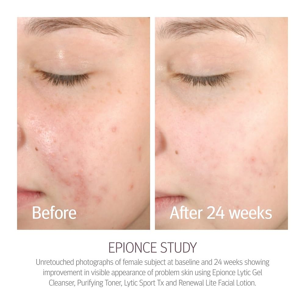 Epionce Renewal Lite Facial Lotion - Lightweight Hydrating, Anti-Aging Moisturizer for Combination to Oily & Problem Skin, Derma