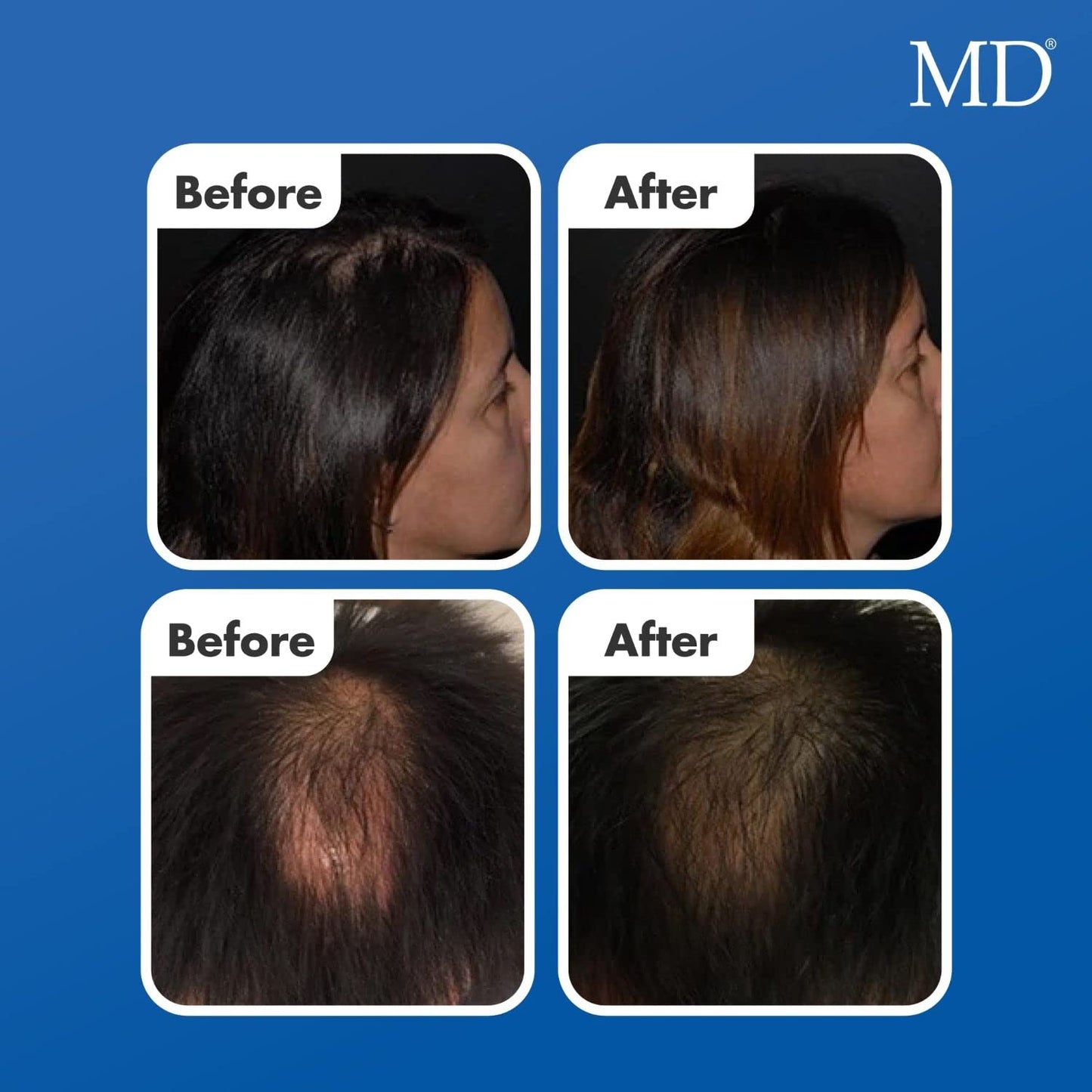 MD Factor Natural Hair Growth Serum | Follicle Energizer Serum - Prevents Thinning Hair & Hair Loss By Stimulating Hair Follicle
