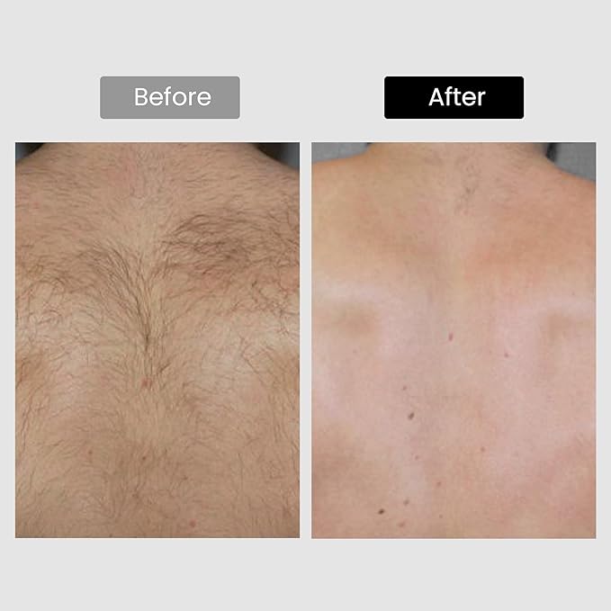 Diode Laser Hair Removal, Hair Removal Device for Skin Tone 1-5, Permanent Reduction in Hair Regrowth, Home-use Wide-Angle 810nm Laser Hair Removal Device