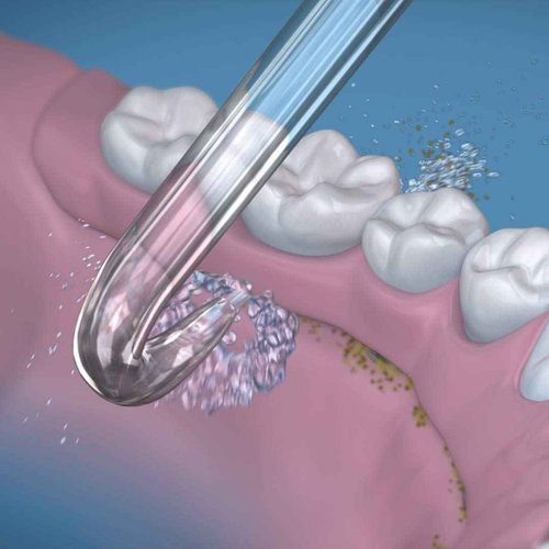 Waterpik Water Flosser Classic Professional WP 72, Countertop Oral Irrigator, White & DT-100E Implant Denture Replacement Tips Water Flosser Tip Replacement, Clear, 2 Count