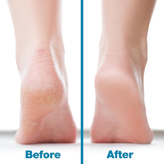 Probelle Double Sided Multidirectional Nickel Foot File Callus Remover - Immediately Reduces calluses and Corns to Powder for Instant Results, Safe Tool (Blue)