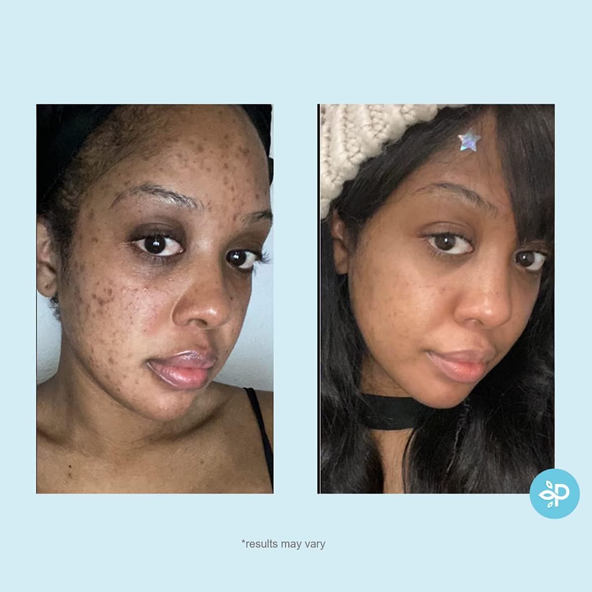 Salicylic 10% Gel Peel, Breakout and Pore Minimizer and Cleanser, 15-30 Full Facial Chemical Peels, 1 fl oz. e, 30 mL - Perfect