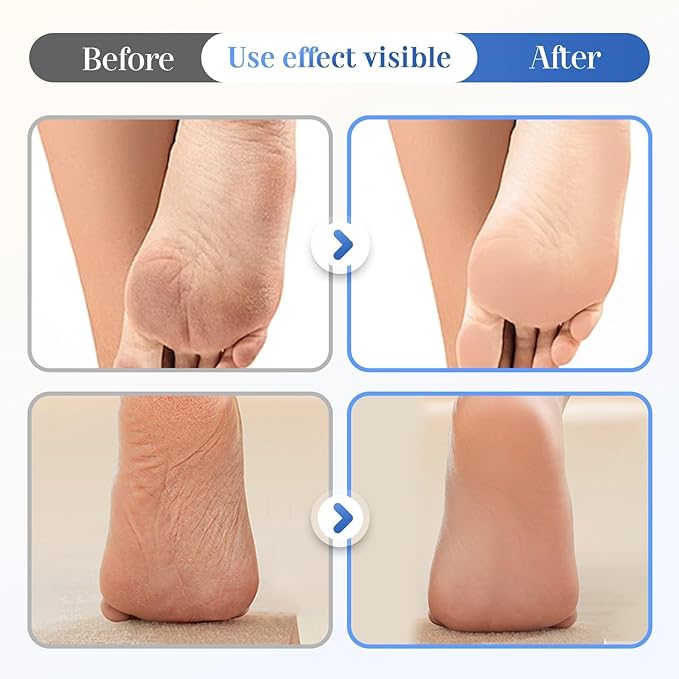 60% Urea Hydrating and Anti-Cracking Foot Cream, 2026 New Hand and Foot Cream Urea Moisturizer, Moisturising and Relieves Cracking and Dryness Foot Creams (3)
