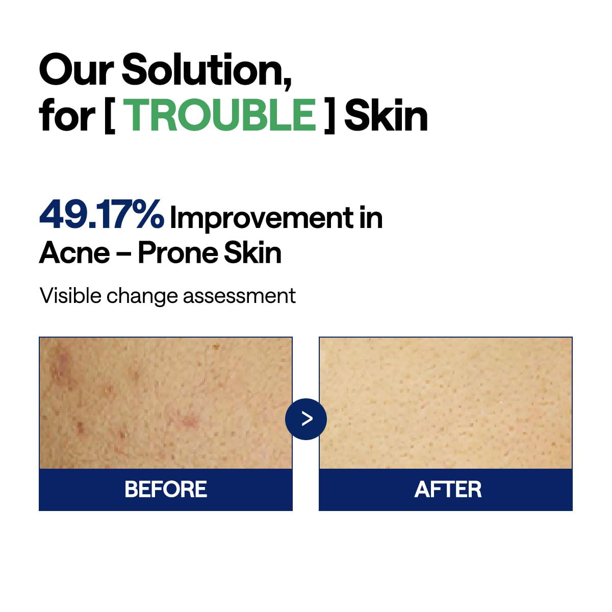 MEDIHEAL Teatree Trouble Facial Toner Pads with Tea Tree & Lactobacillus - Calming & Soothing for Sensitive & Acne Prone Skin -