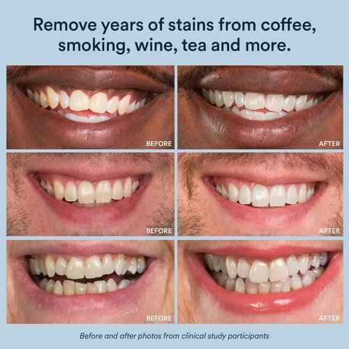 Auraglow Teeth Whitening Kit & 44% Teeth Whitening Gel Refill Pack