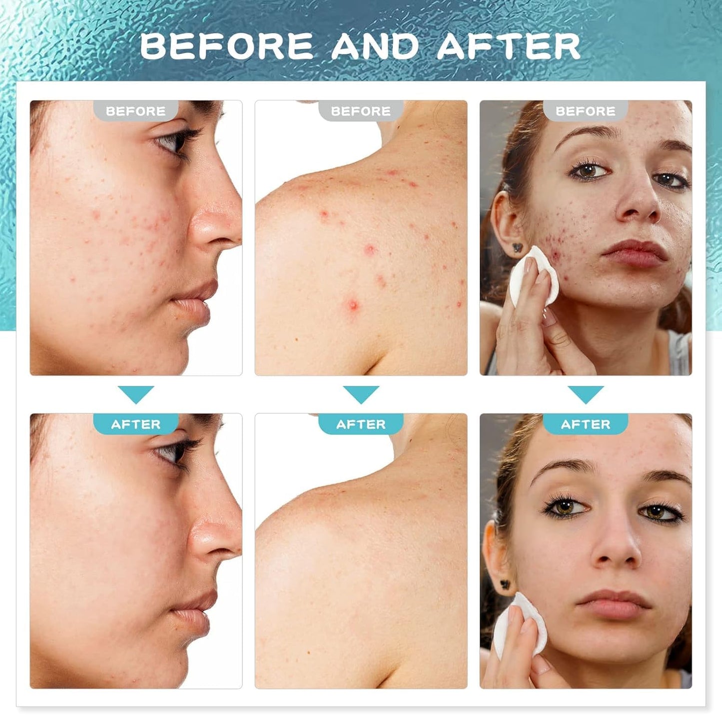 Paradise Emerald Acne Treatment for Face: Salicylic Acid Serum for Acne-Prone Men Women - Pimple Cream for Body Back