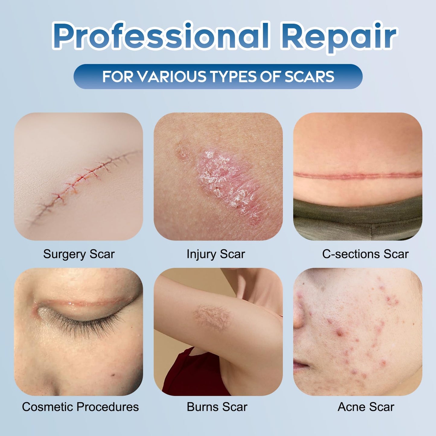 Advanced Silicone Scar Gel for Face & Body - Silicone Scar Cream for Old & New Scars, Reduces Appearance of Scars from Acne, Sur