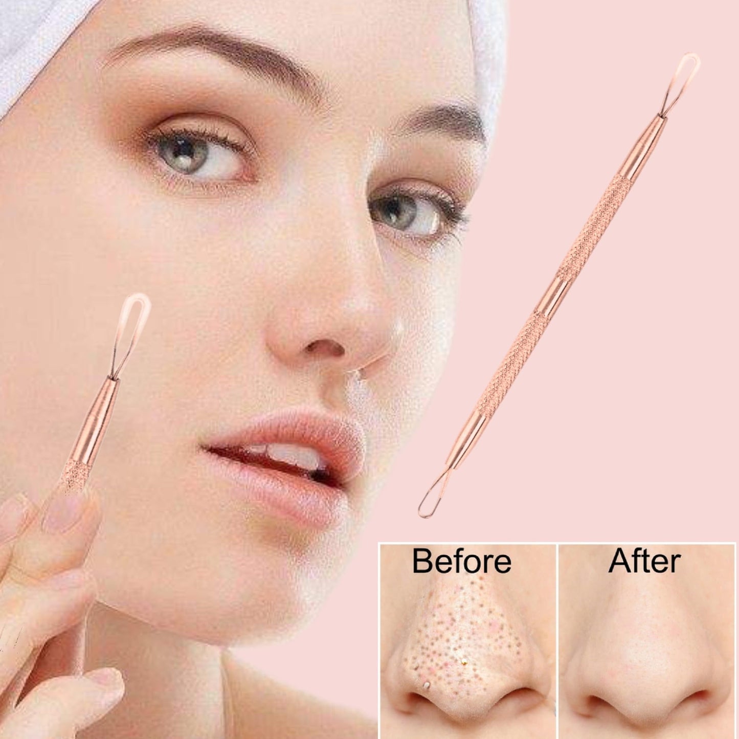 2 Professional Stainless Steel Blackhead Remover Blemish Extractor Tool - Acne Skin Nose Face Tzone Whitehead Zit Pimple Popper
