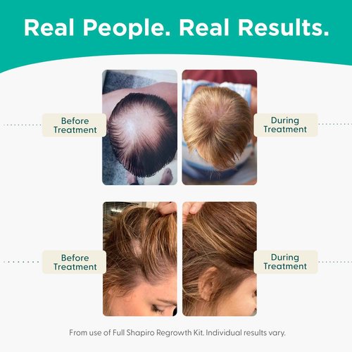 Shapiro MD Hair Growth Experts Shampoo and Conditioner with 100% Vegan Formulas, DHT Fighting Treatments for Thinning Hair Developed by Dermatologists, Fuller & Thicker Looking Hair, 1 Month Supply