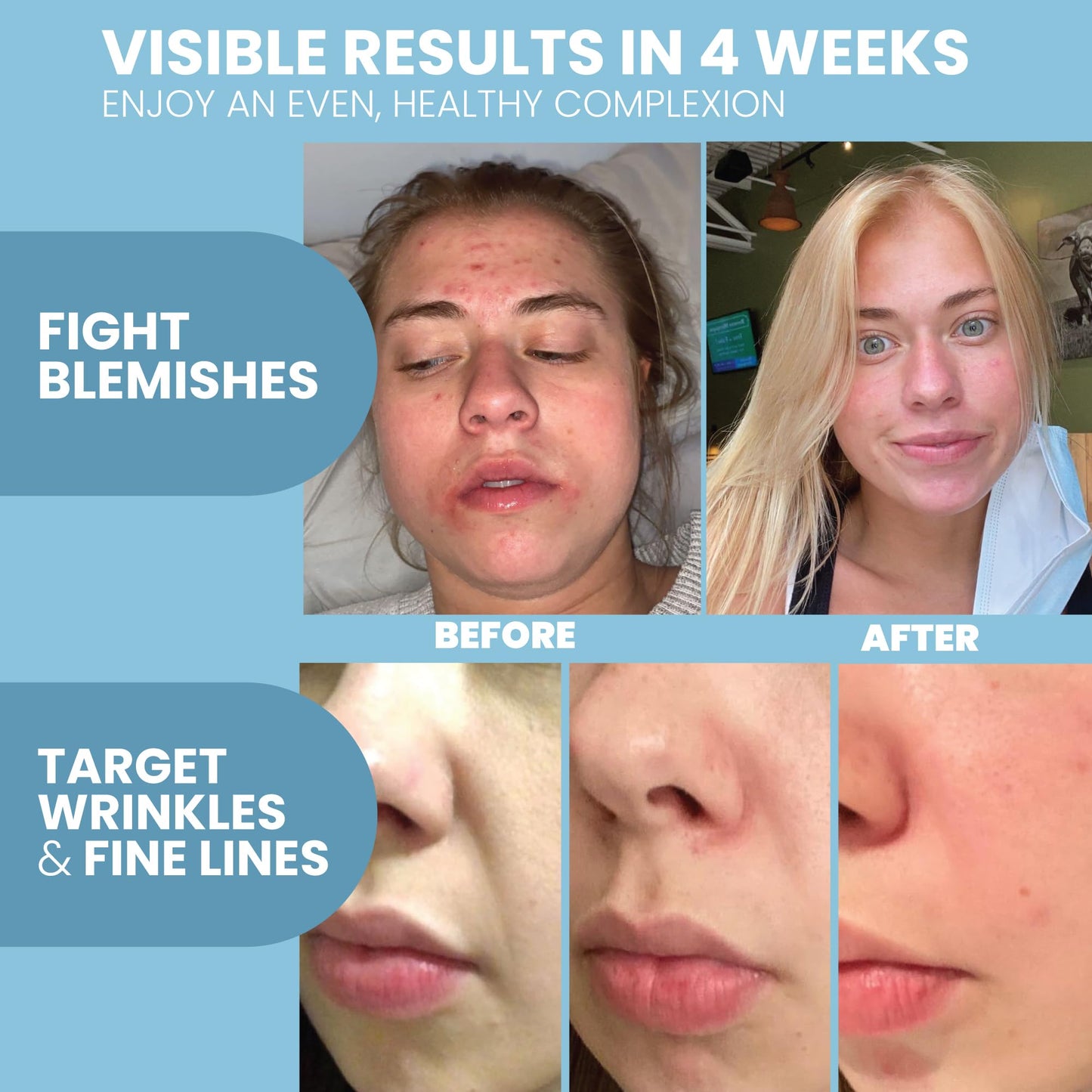 Retinol Serum for Face with Hyaluronic Acid & Vitamin E - For Anti-Aging, Fine Lines, Wrinkles, Resurfacing, Acne Marks and Scar