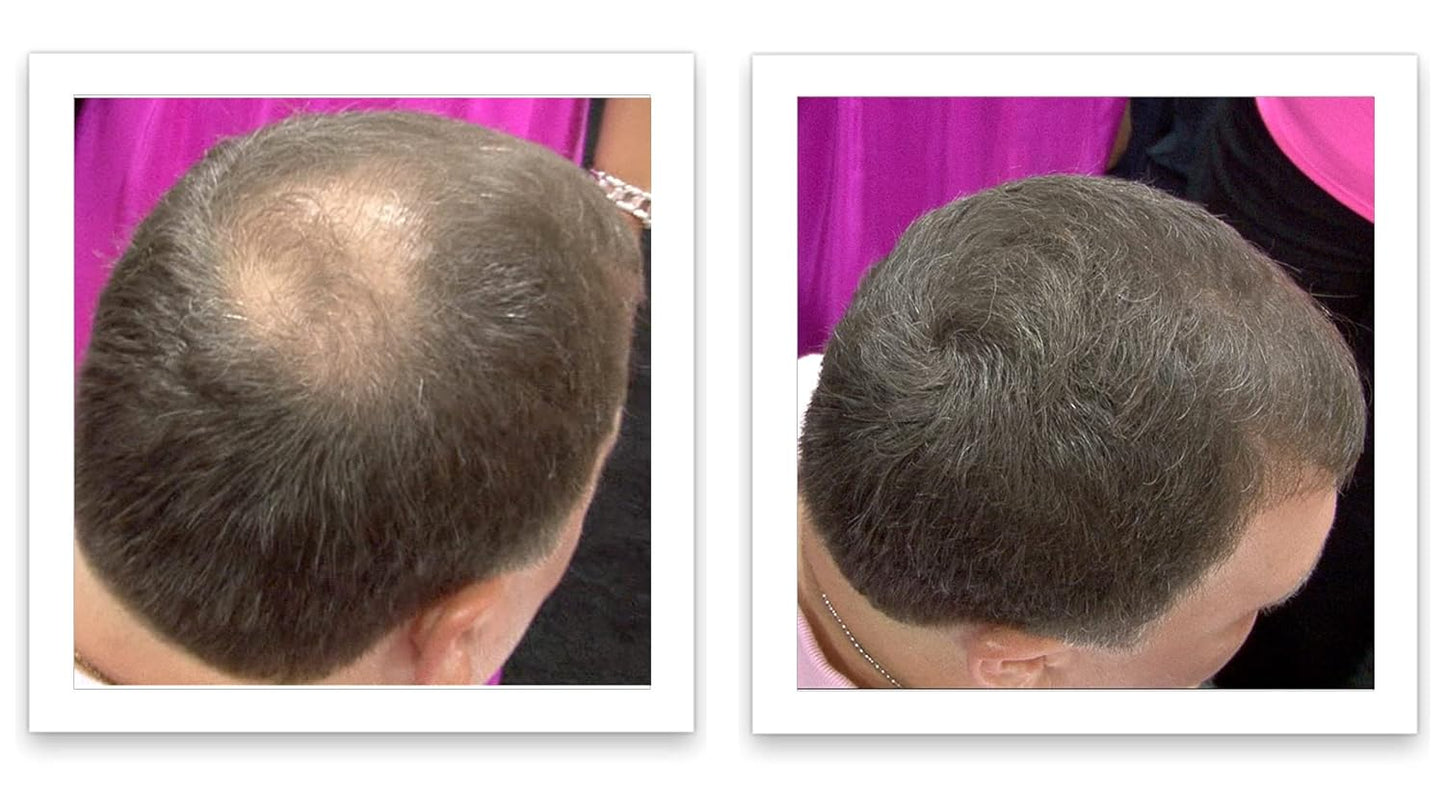 Caboki All-Natural Hair Building Fiber. Make Thin Hair Look 10X Fuller Instantly. Eliminate the Appearance of Bald Spot and Thinning Hair (30G, 90-Day Supply). Medium Brown