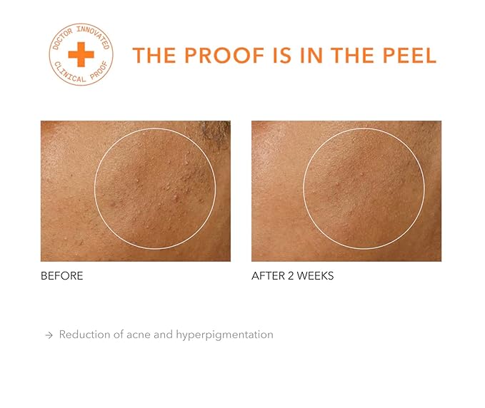 Dr Dennis Gross Alpha Beta Universal Daily Peel: for Uneven Tone or Texture and Fine Lines or Enlarged Pores, (5 Treatments)
