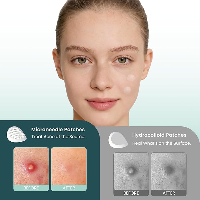 Micro-Dart Pimple Patch – Hydrocolloid Acne Patches with Micro-Dart Technology for Hydrolyzed Hyaluronic Acid, Salicylic Acid, Madecassoside & Tea Tree (18 Pack)