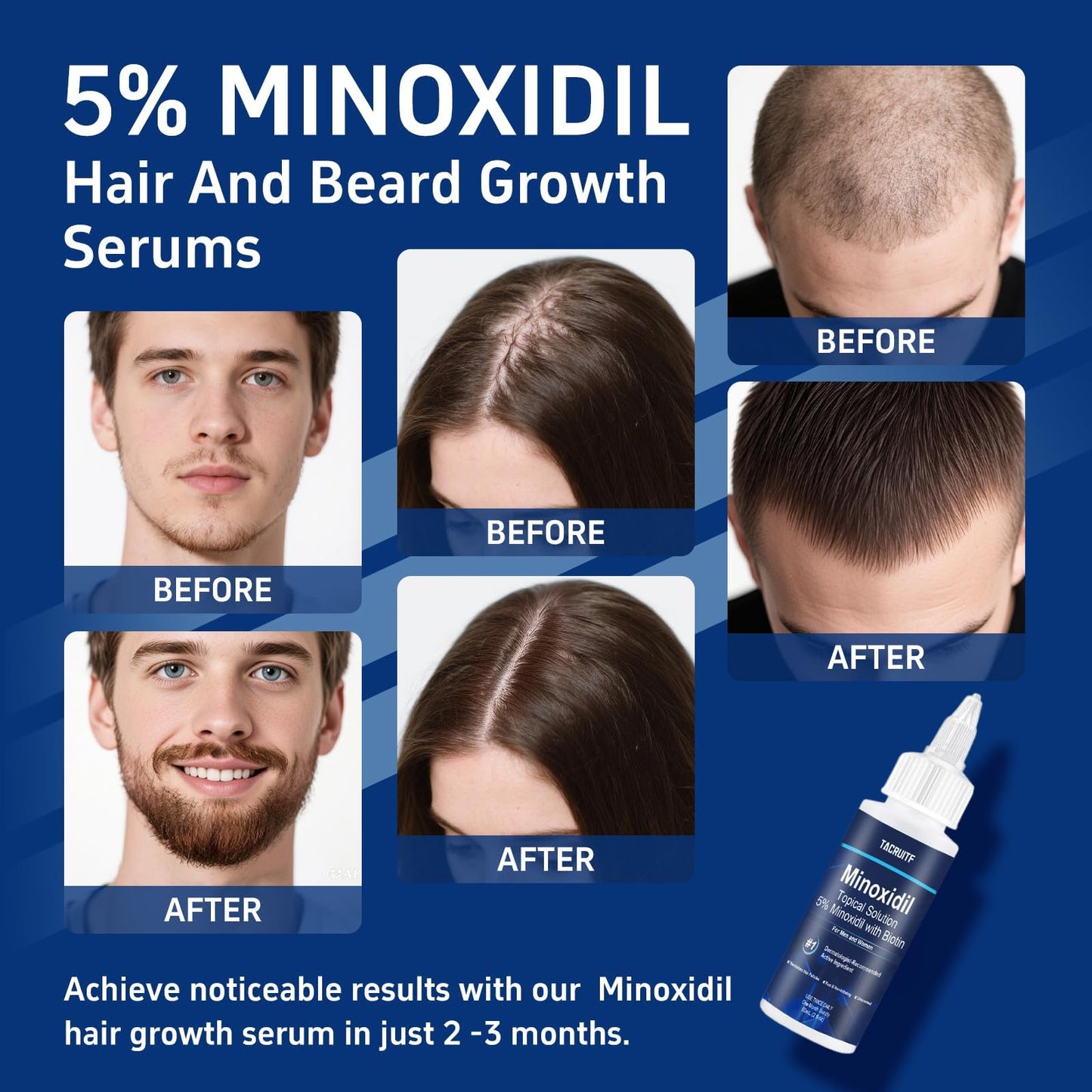 6 Packs, 5% Minoxidil with Biotin, Hair Growth Treatment, Minoxidil Hair and Beard Growth Oil, Minoxidil for Men and Women, Supp