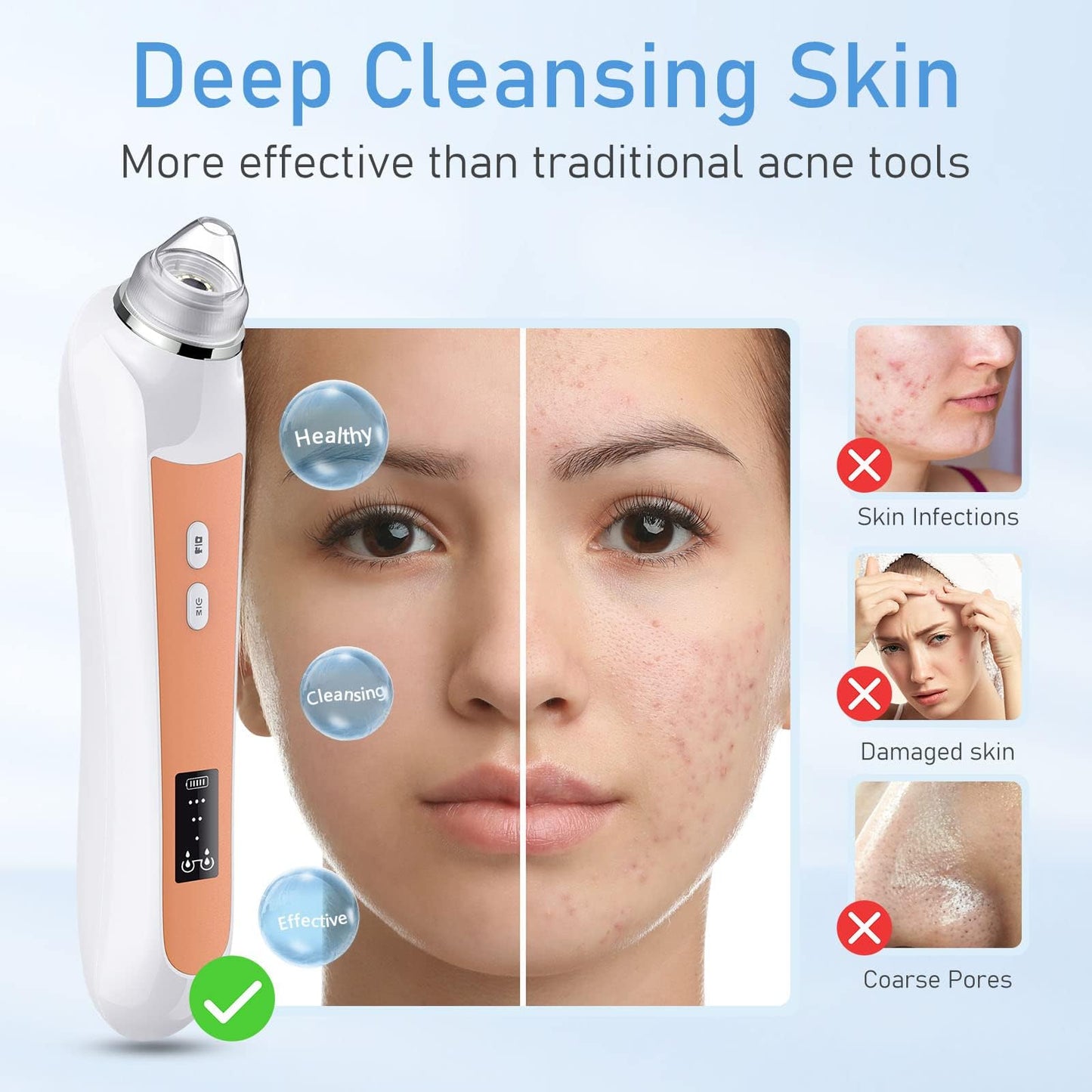 Facial Pore Blackhead Remover Vacuum, 1080P Camera Blackhead Remover, 20x Zoom, 8 LEDs & 3 Suction Modes, 800mAh Battery & USB -