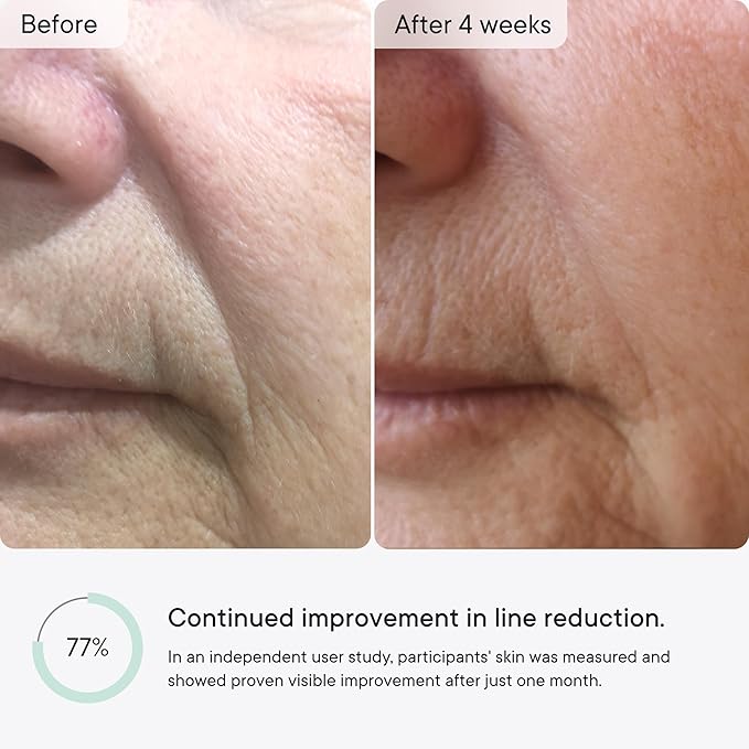 Qure Micro-Infusion Anti Wrinkle Patches for Smile Line, Frown lines, Under Eye Bags, Puffiness, Crow's Feet - Retinol, Caffeine, Niacinamide & Peptides - Dissolvable for Overnight Use - 16 Pairs