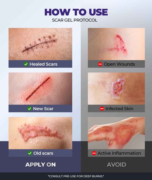 Silicone Scar Cream with 6.7% Active Ingredients, Scar Gel Visible in 2 Weeks, Moisturizing Scar Removal Clinically Show for Surgical, C-Section, Keloid, Acne & Burn Scars, Stretch Mark Cream(55ML)