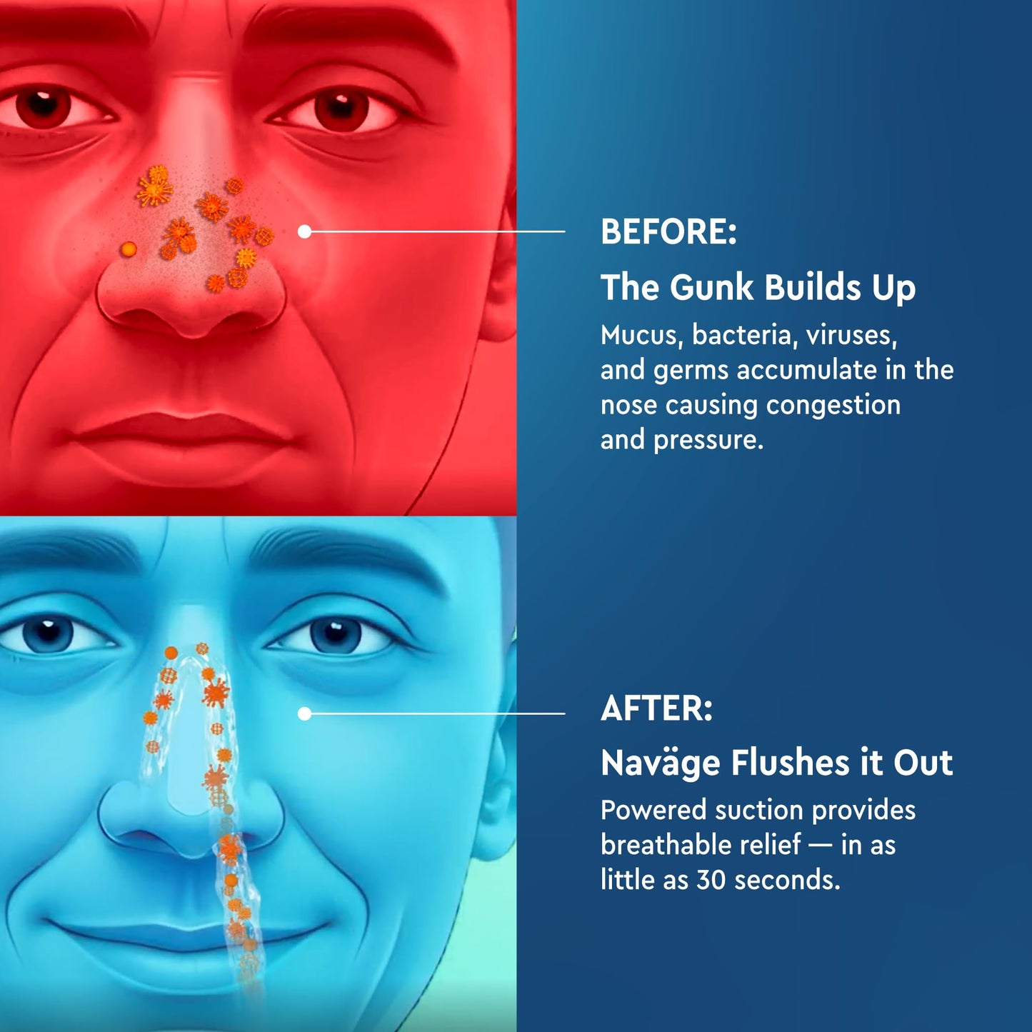 Navage Starter Bundle - Nasal Irrigation System - Saline Nasal Rinse Kit with 1 Navage Nose Cleaner and 30 Salt Pods