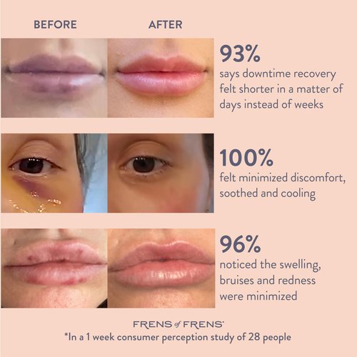Frens of Frens Aesthetic Aftercare | TAKE After CARE Arnica & Bromelain Gel for Bruising, Swelling after Fillers, Cosmetic Injections | Cooling Depuff Serum Face Roller | 100% Vegan (30ml)