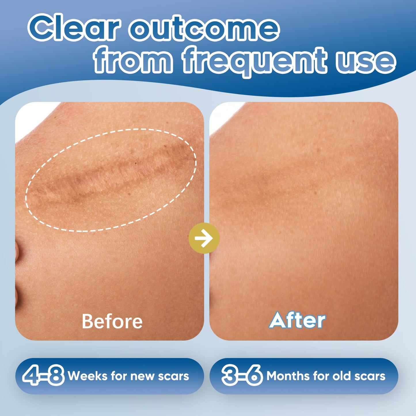 Advanced Silicone Scar Gel for Face & Body - Silicone Scar Cream for Old & New Scars, Reduces Appearance of Scars from Acne, Sur