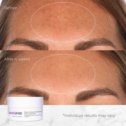NassifMD Even, Correct & Renew Retexturizing Pads | Chemical Peel for Face | Whitehead, Closed Comedone and Acne Marks Skin Resurfacing Pads | Hyperpigmentation Treatment for Face