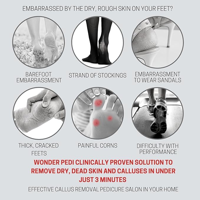 Callus Remover - Three Minutes Fix- Foot File Rasp - Instant Foot Exfoliating Softener Peel Spray, Heels Callus Scrubber File - Home Spa Pedicure Treatment. Wonder Pedi