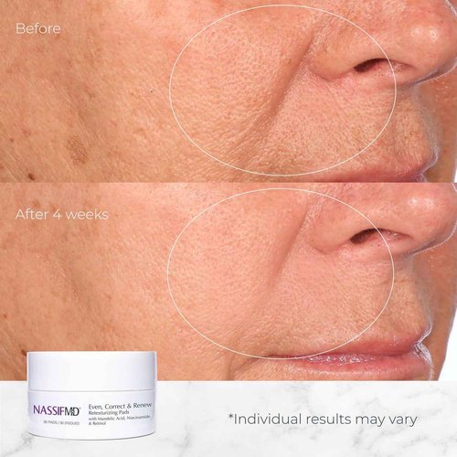 NassifMD Even, Correct & Renew Retexturizing Pads | Chemical Peel for Face | Whitehead, Closed Comedone and Acne Marks Skin Resurfacing Pads | Hyperpigmentation Treatment for Face