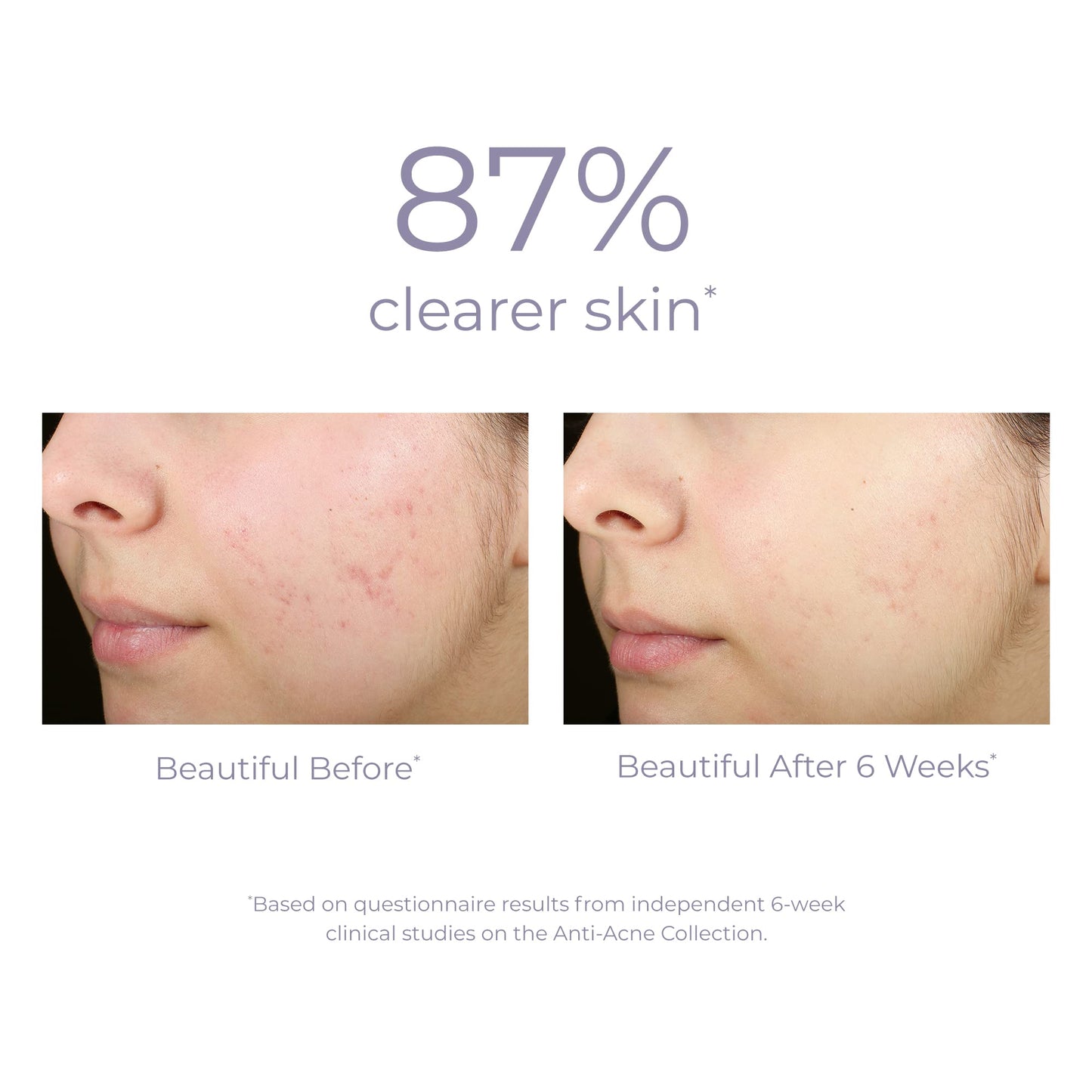 Derma E Acne Deep Pore Cleansing Wash - Blemish Control Facial Cleanser with Salicylic Acid - Gentle Oil Control Face Wash Sooth