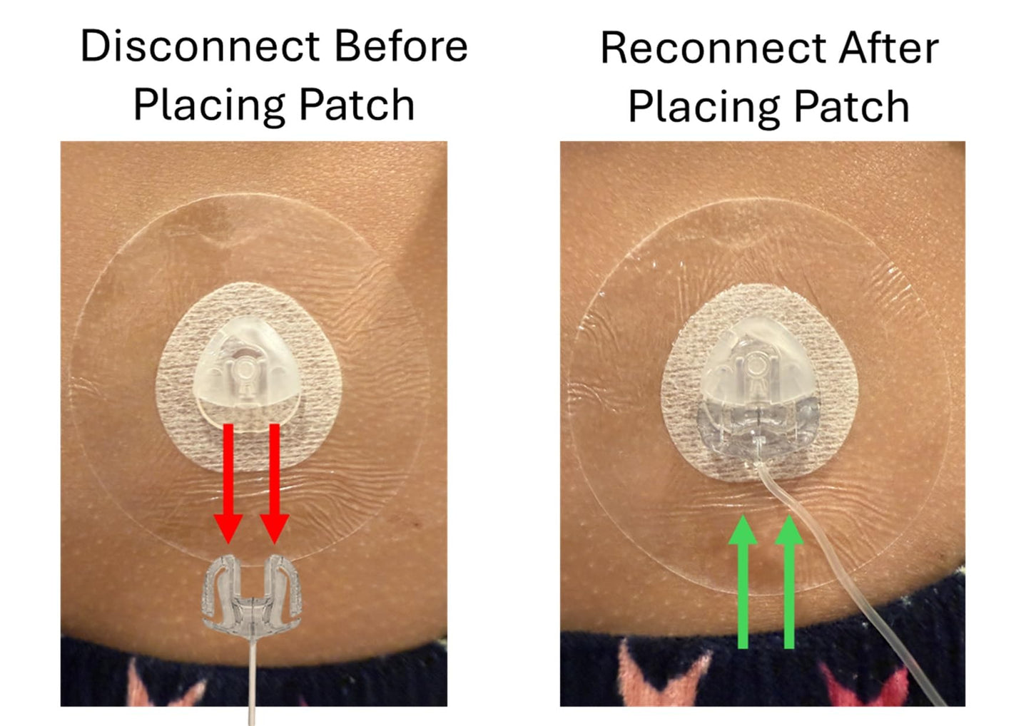 A1C WEAR - 30pk Overpatches for AutoSoft XC, 90, 30, MiniMed Mio, Extended, Varisoft 13mm, Inset - Triangle Style Infusion Sets - Waterproof, Transparent, Breathable, Long Lasting