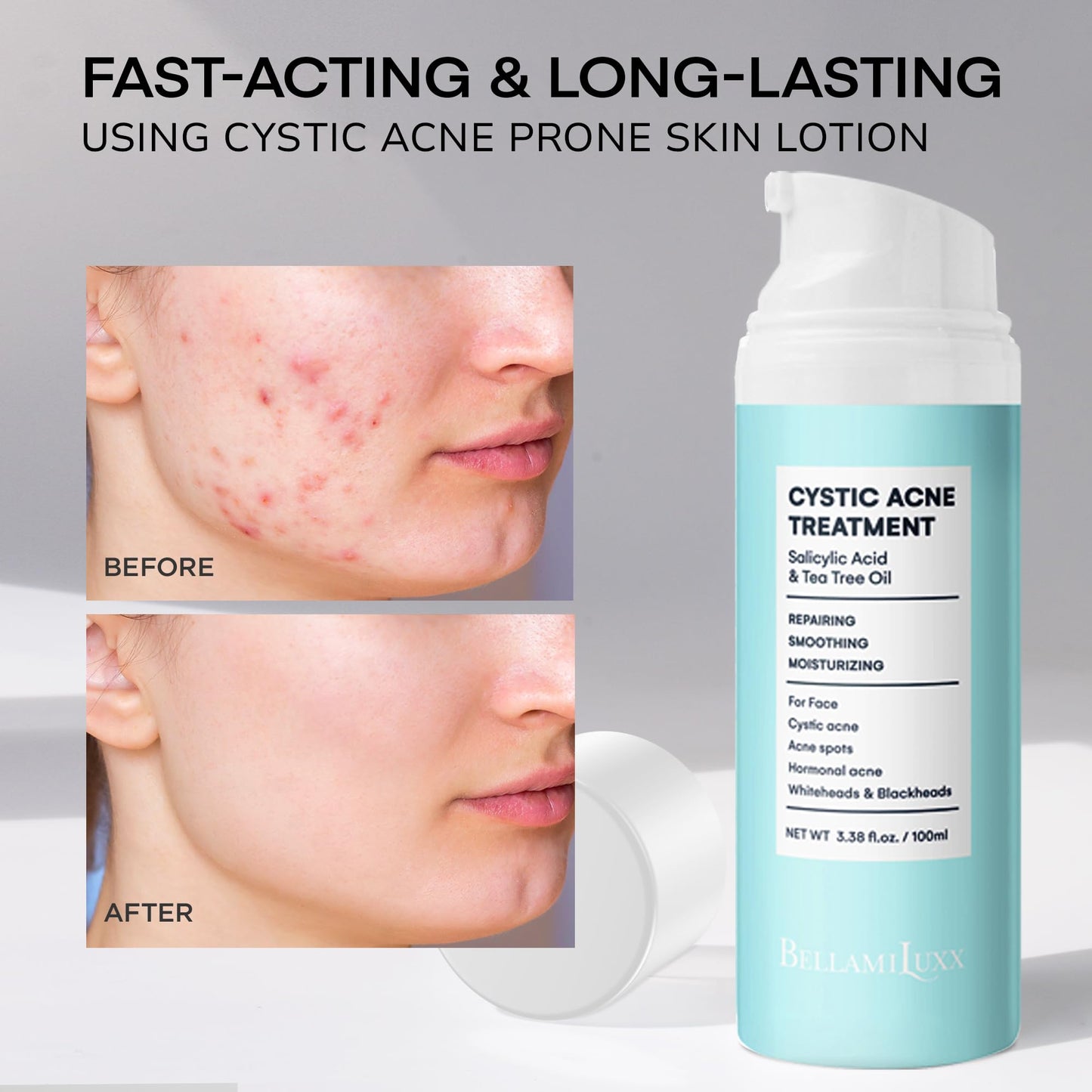 BellamiLuxx Cystic Acne Treatment for Face: Hormonal Acne Treatment Cream for Teens & Adults - Salicylic Acid & Tea Tree Oil Pimple Spot Remover - Anti-Acne Moisturizer Reduces Redness, Blemishes