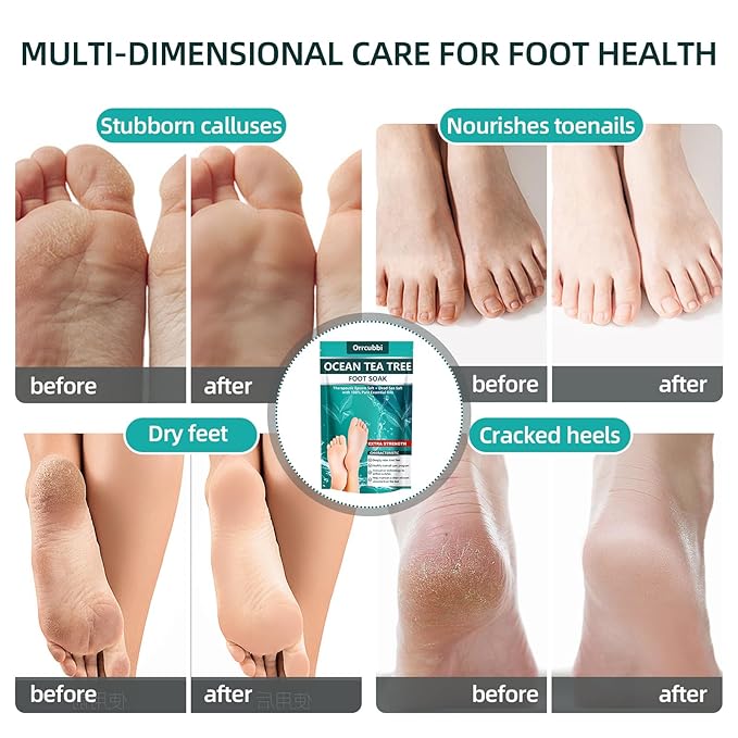 EXTRA STRENGTH Ocean Tea Tree Oil Foot Soak Salt – Dead Sea & Epsom Salt with Natural Essential Oils – Foot Bath for Odor, Callus Softening & Toenail Care – Relax Tired Feet, Home Spa Use 16oz
