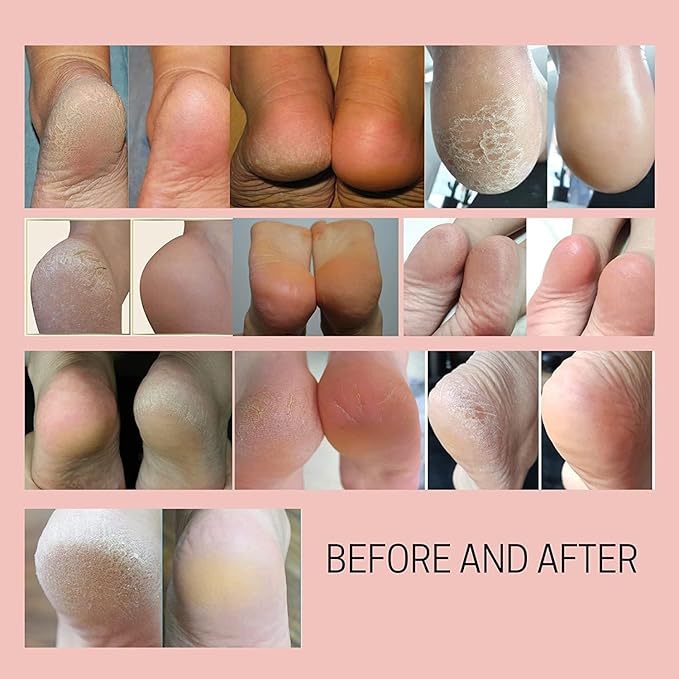 Callus Remover - Three Minutes Fix- Foot File Rasp - Instant Foot Exfoliating Softener Peel Spray, Heels Callus Scrubber File - Home Spa Pedicure Treatment. Wonder Pedi