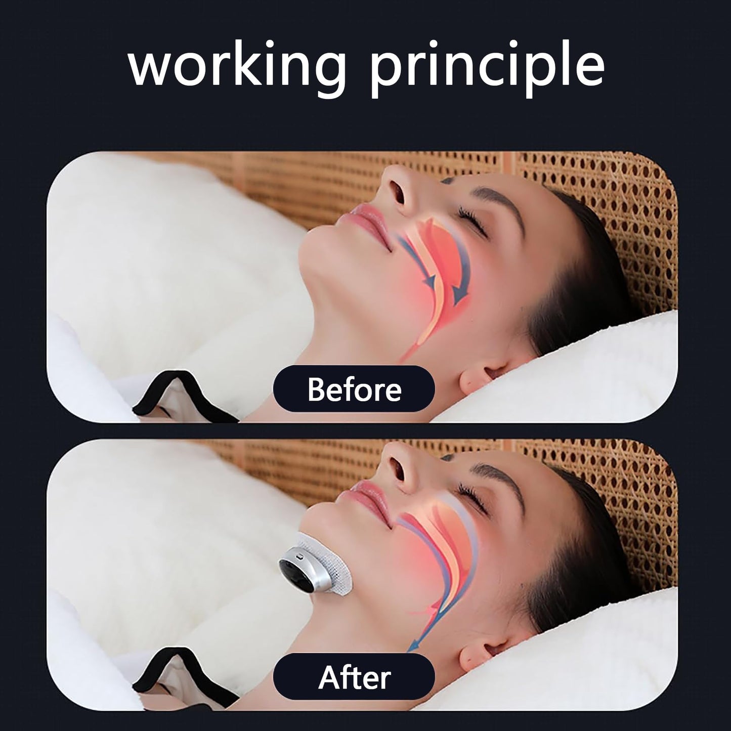 Electric Anti Snoring Bean Accessories, Accessories for Anti Snoring Devices(Electrode Plate-20)