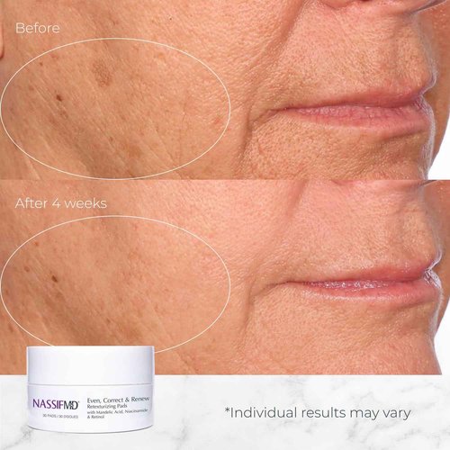 NassifMD Even, Correct & Renew Retexturizing Pads | Chemical Peel for Face | Whitehead, Closed Comedone and Acne Marks Skin Resurfacing Pads | Hyperpigmentation Treatment for Face