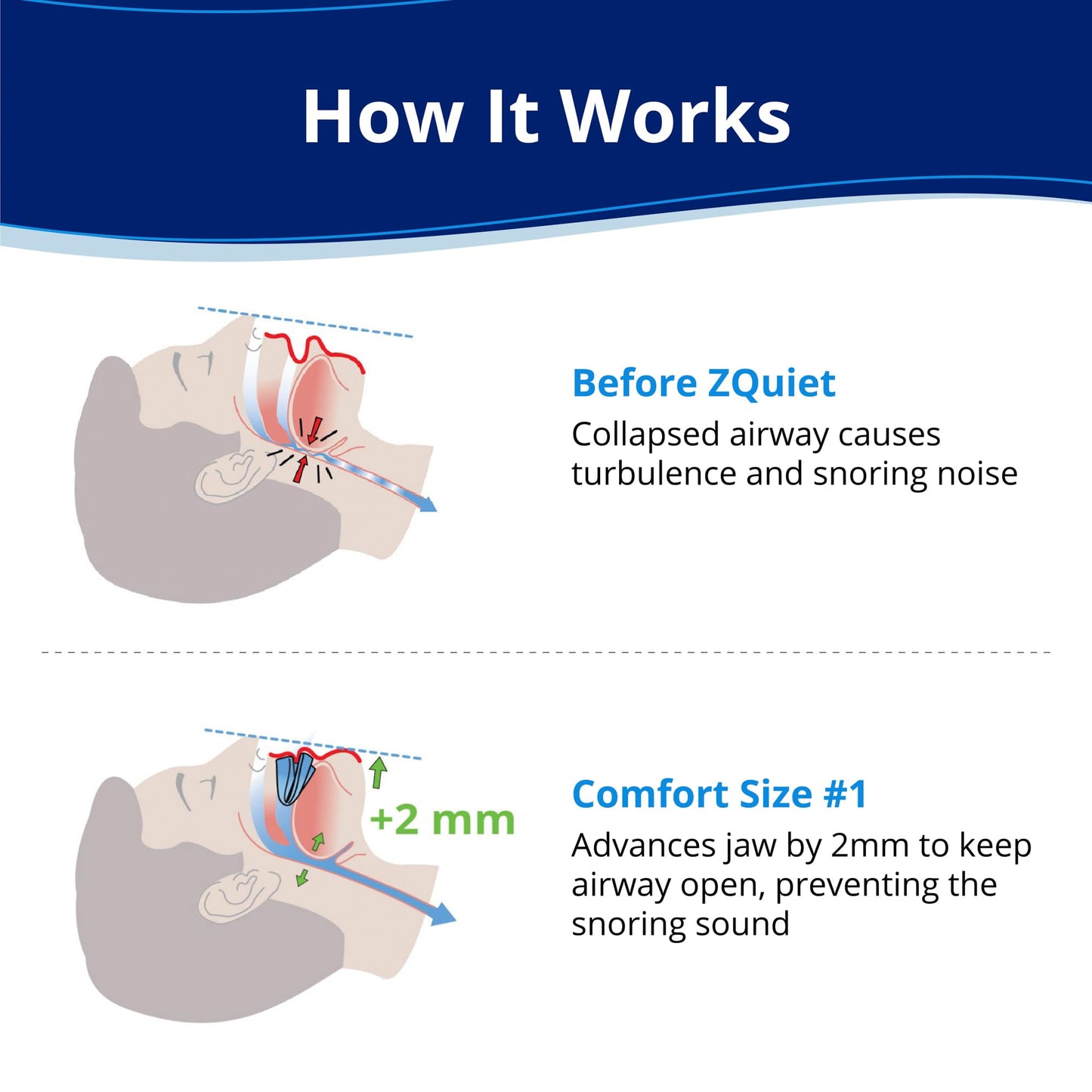 ZQuiet, Anti-Snoring Mouthpiece, Comfort Size #1, Single Refill, Clear, Made in USA, BPA-Free, Medical-Grade Material